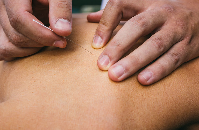 Acupunture